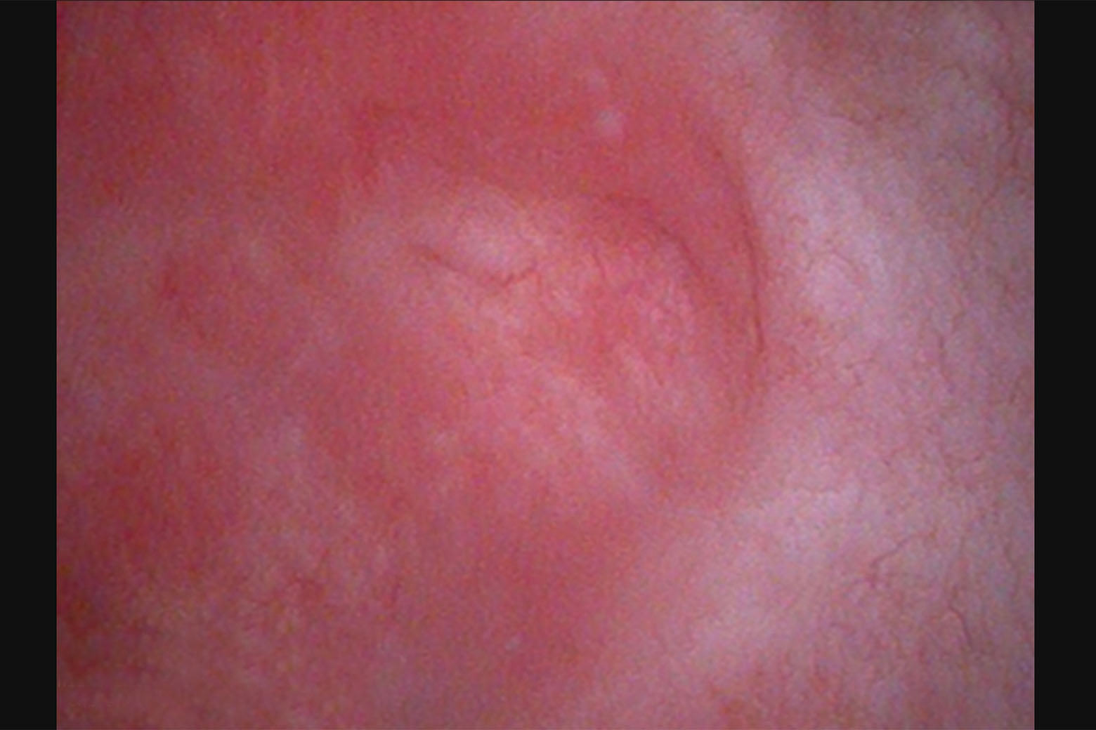 Image From Cystoscopy Revealing Diffuse Erythema, Inflammation And Carcinoma In Situ