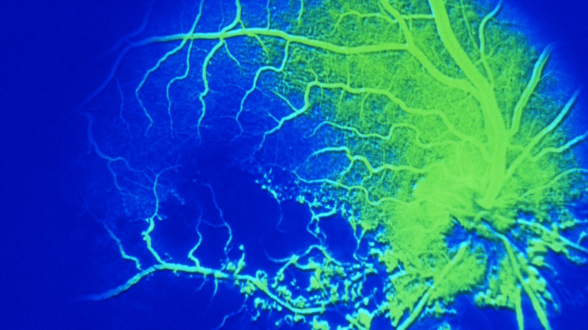 Retinal Vein Occlusion Illuminated by Fluorescein Angiogram