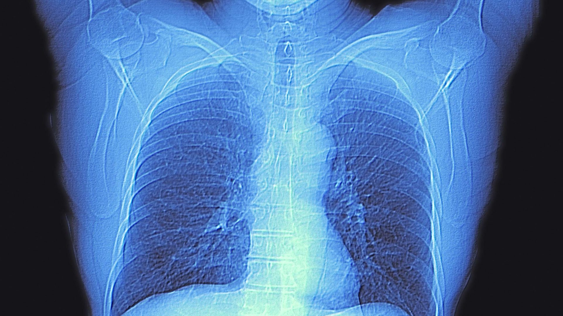 CT Scan of Chest Showing Heart and Lungs