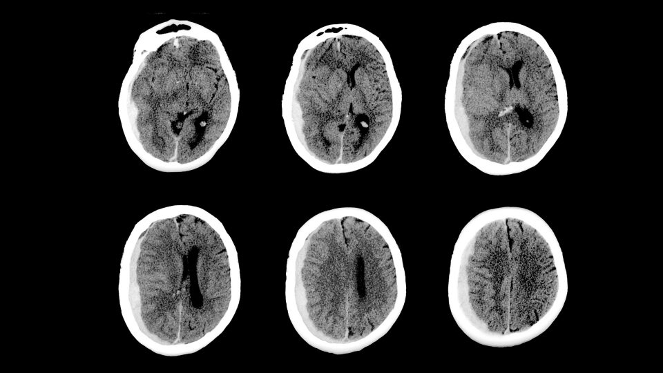 Series of CT scans of head with subdural hematoma