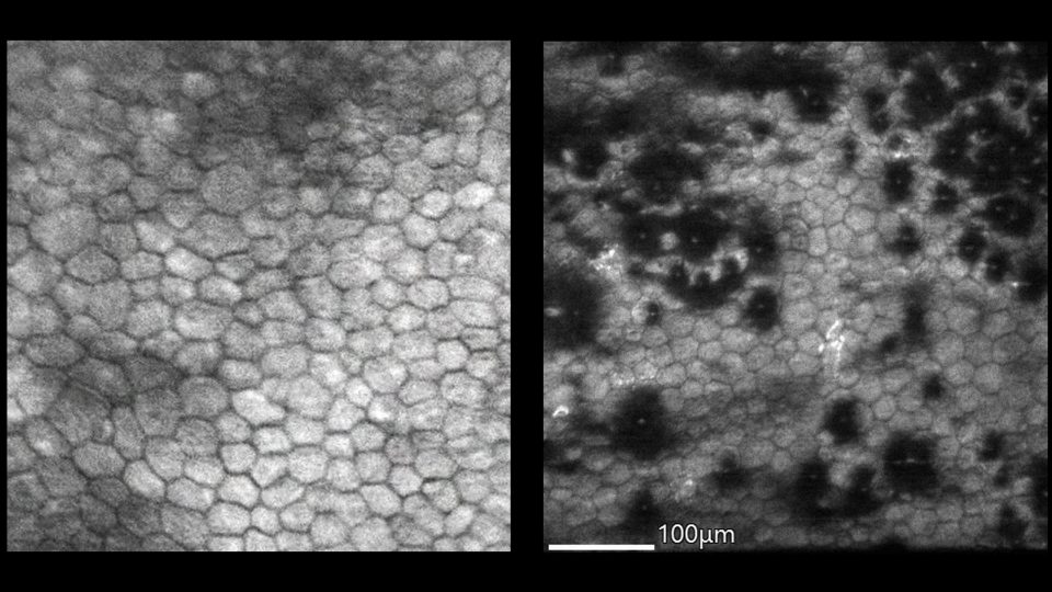 Microscopic view of corneal endothelial cells from a healthy patient (left) and a patient with Fuchs dystrophy (right)