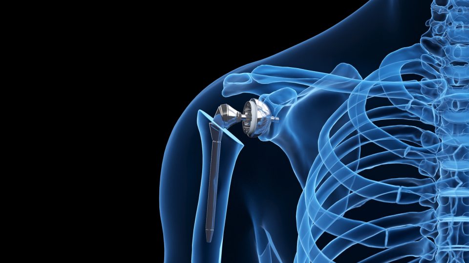 Illustration of shoulder replacement