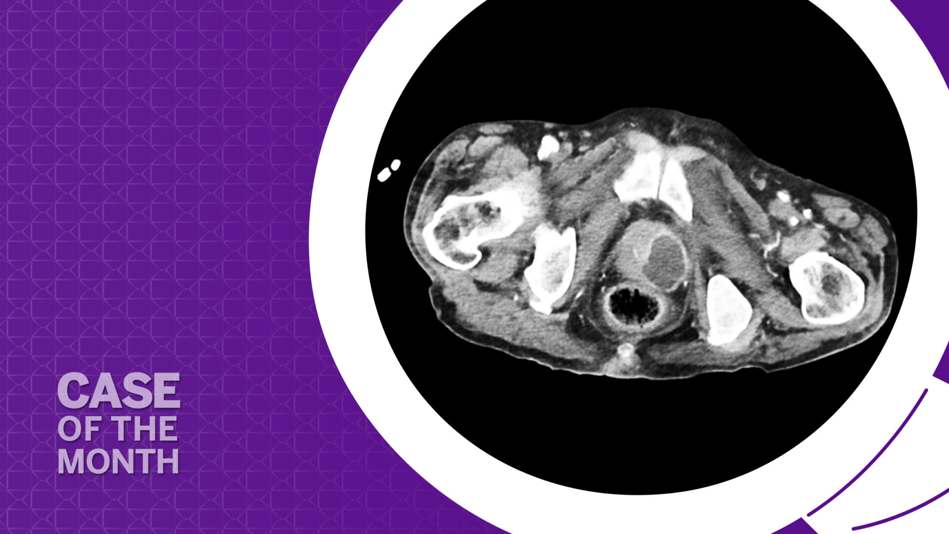 CT scan of the patient’s pelvis demonstrating a prostatic abscess.