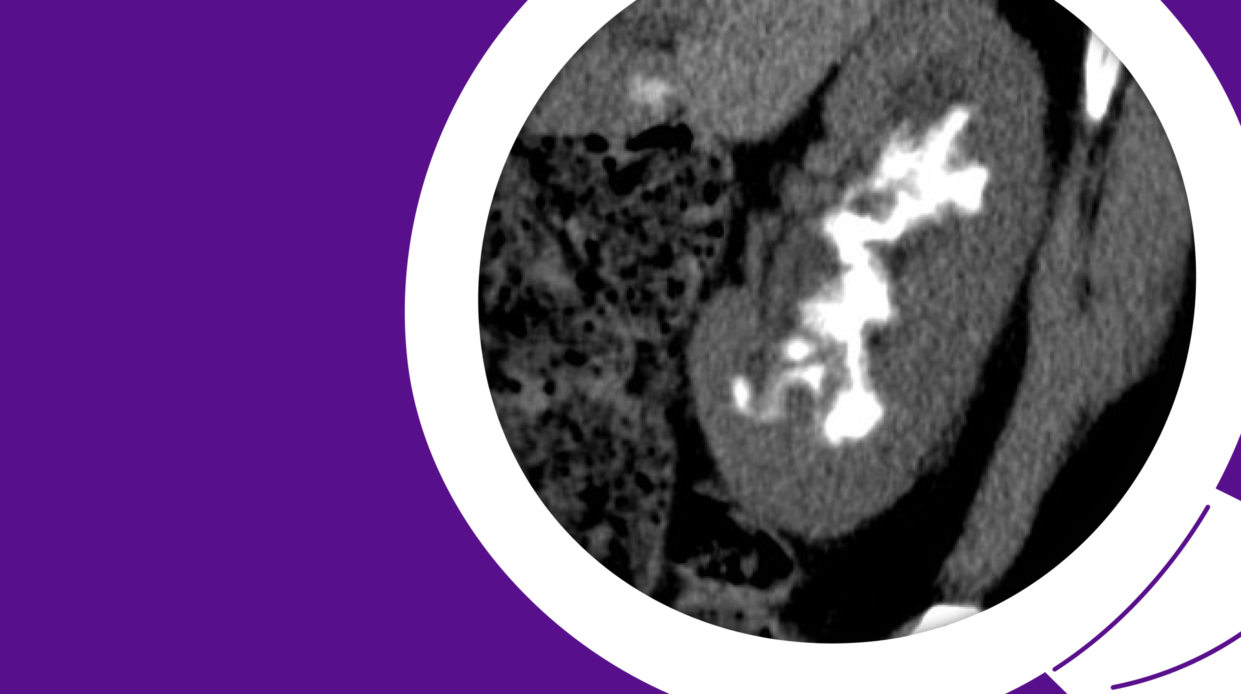 Opting for Oral Therapy: Encrusted Pyelitis Managed Without Invasive ...